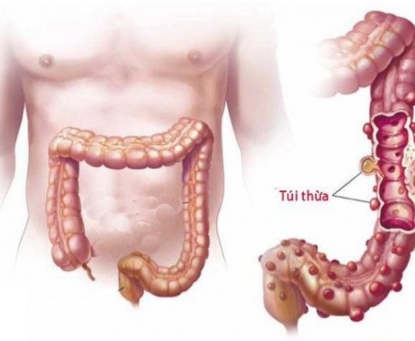 Tổng quan bệnh túi thừa đại tràng